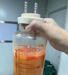 江山水动力吸脂手术要做多久？